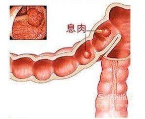 肠子长息肉应该如何治疗