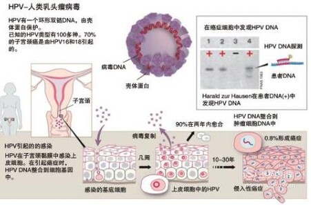 感染HPV病毒一定会得宫颈癌吗