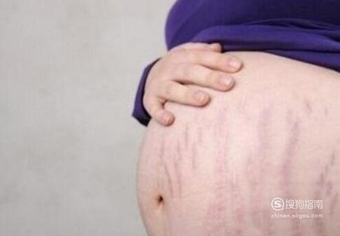怀孕了，肚子上长妊娠纹怎么办？
