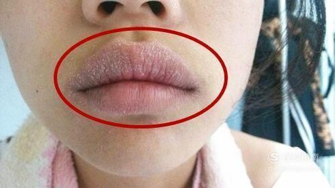 嘴唇起皮、干裂怎么办？如何保护嘴唇？