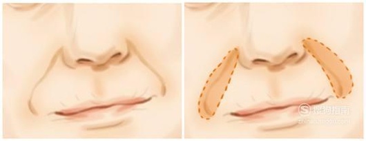 做胶原蛋白填充鼻唇沟效果怎么样？能保持多久？